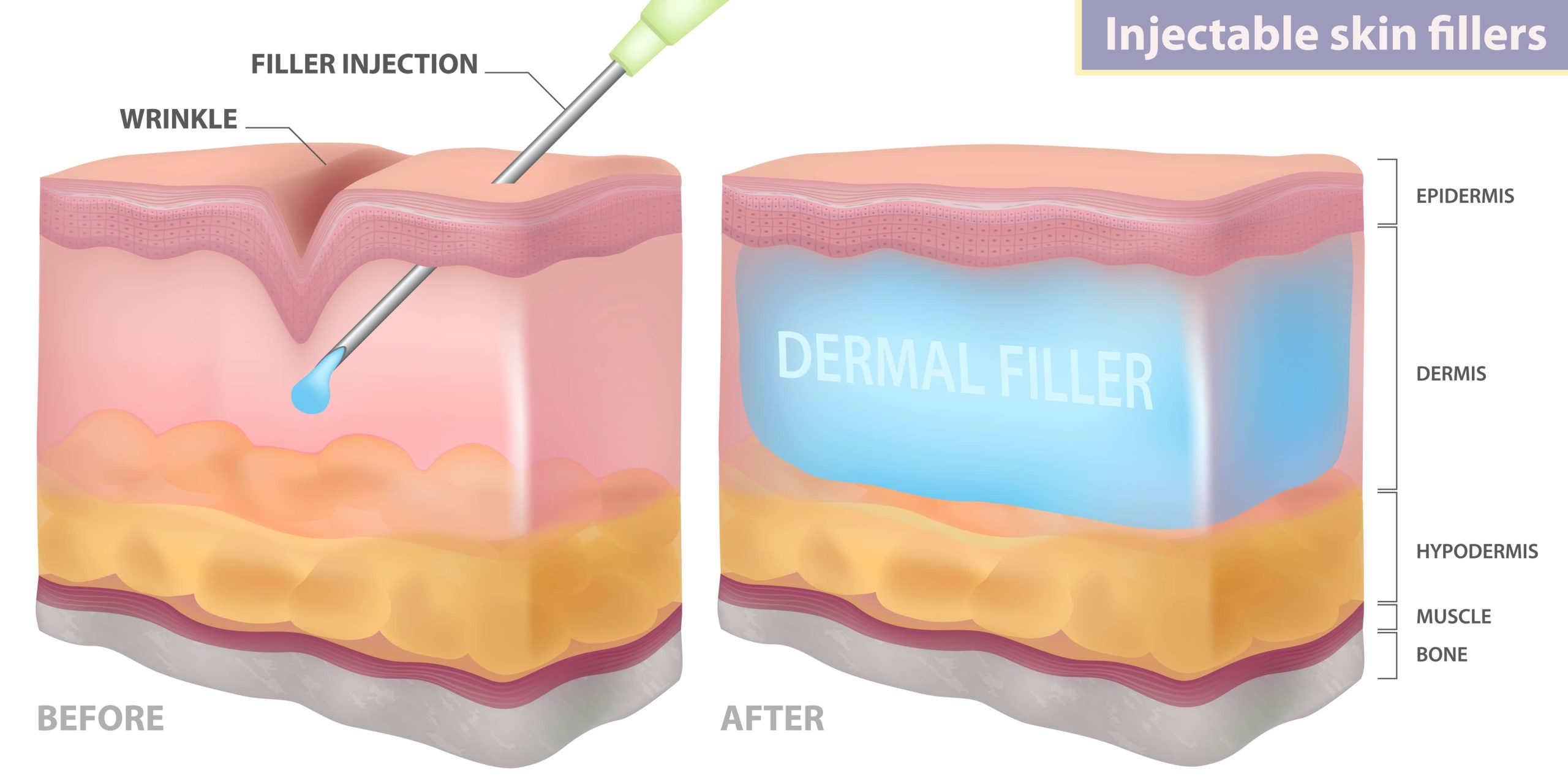 How Can A Dermal Filler Remove Wrinkles How Can A Dermal Filler Remove Wrinkles