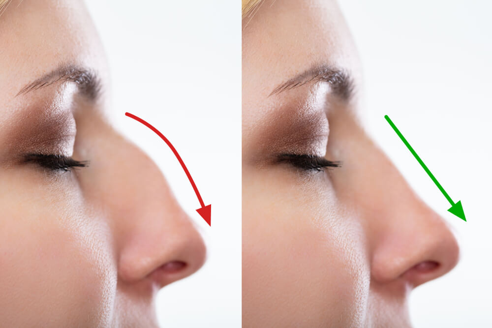 Nose Filler Before And After Nose Filler Before And After