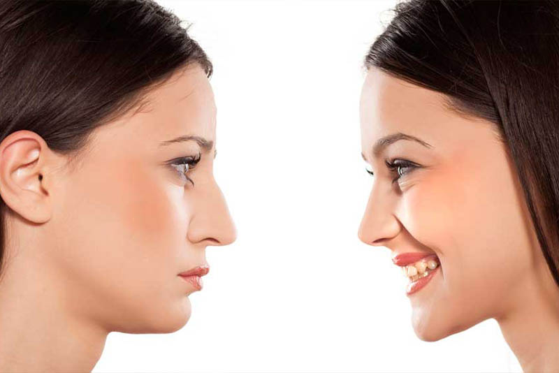 How Much Does Nose Filler Cost In Southampton How Much Does Nose Filler Cost In Southampton