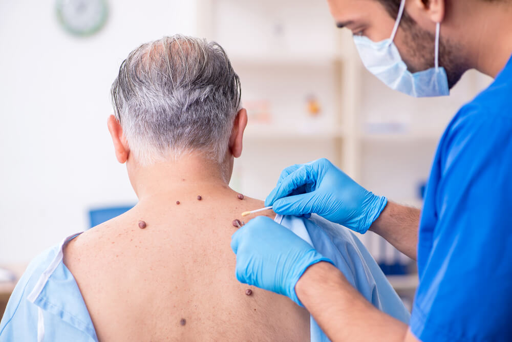 Man removing mole with cryotherapy in Southampton Man removing mole with cryotherapy in Southampton