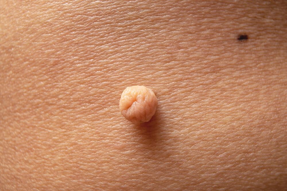 Remove skin tag cryotherapy Southampton Remove skin tag cryotherapy Southampton